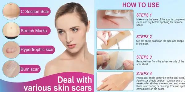 hojas de silicona para cicatrices oferta